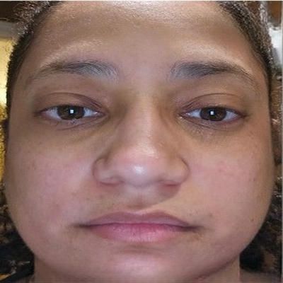 A close up of a woman 's face before microneedling treatment.