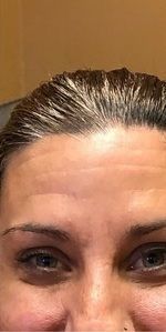 A close up of a person 's forehead without wrinkles after botox treatment.
