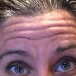 A close up of a person 's forehead with wrinkles before botox treatment.