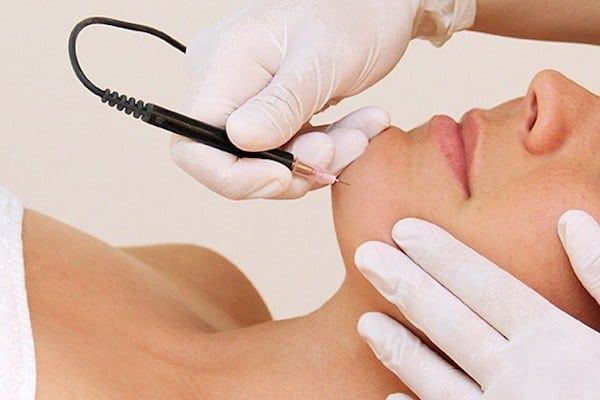 A woman is getting a electrolysis treatment on her face.