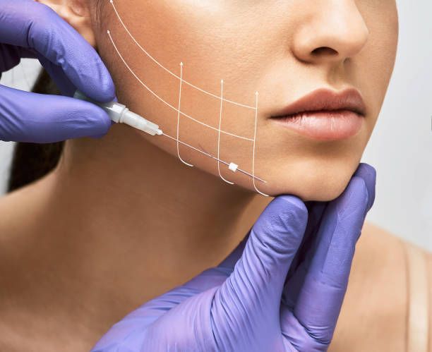 A woman is getting a thread lift service on her face.