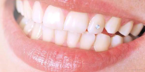 Zahnschmuck: Das gewisse Extra für die Zähne