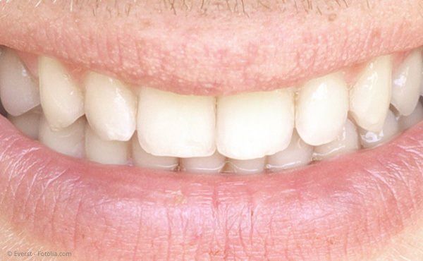 Weiße Zahnfüllungen Ubstadt-Weiher, Zahnarzt Dr. Knebel