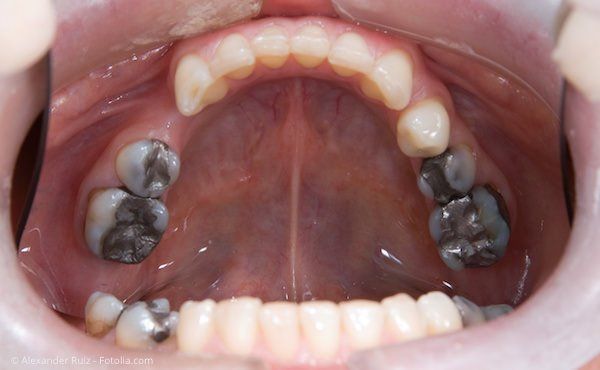 Weiße Zahnfüllungen Ubstadt-Weiher, Zahnarzt Dr. Knebel