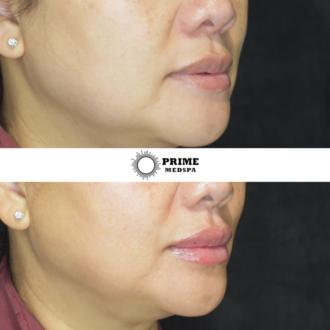 Before & After Treatment Gallery | Portland | Prime MedSpa PDX