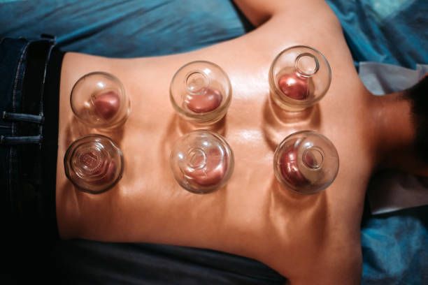 Back of a person with cupping therapy. Clear glass cups are suctioned onto the skin, leaving red marks.