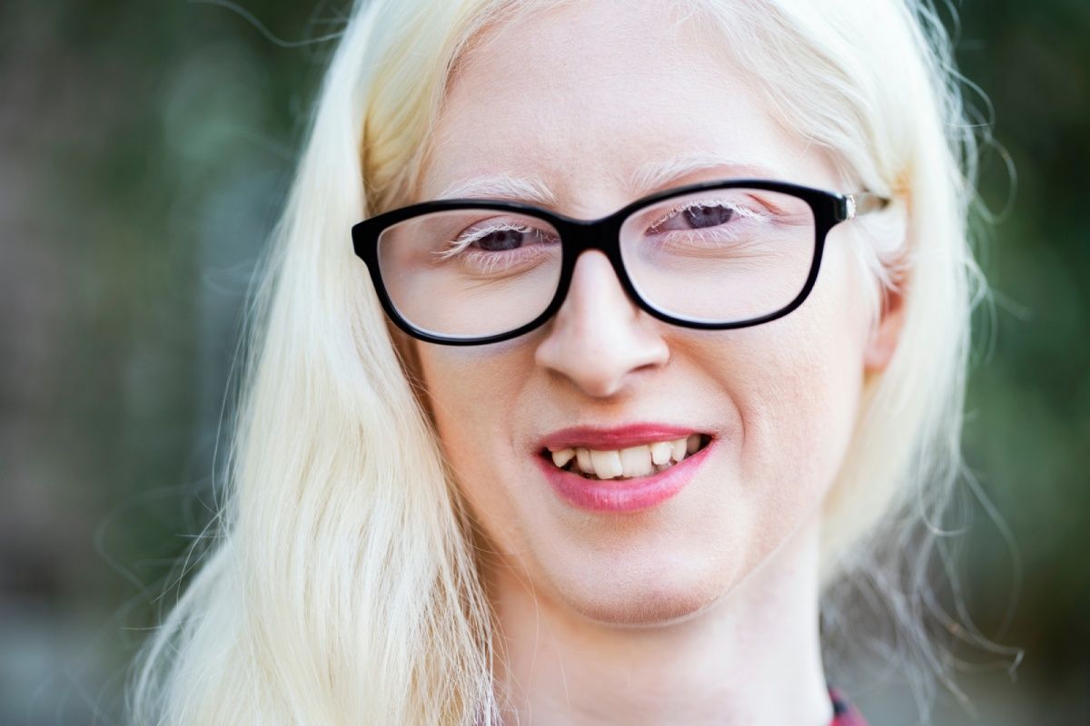 Woman with albinism smiles, wearing black glasses.