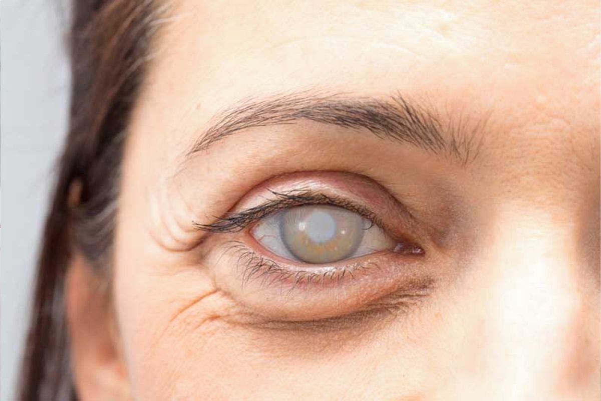 Eye with a cloudy, white eye, indicative of a cataract.