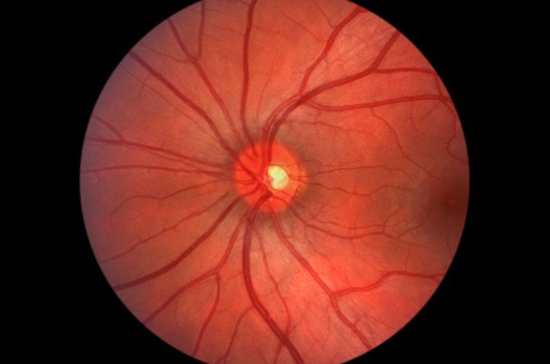 Fundus image showing a healthy optic disc, red retinal vessels radiating outwards, and a dark background.