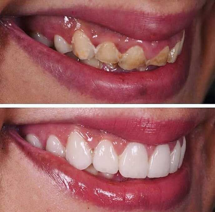 AB Dental - coronas