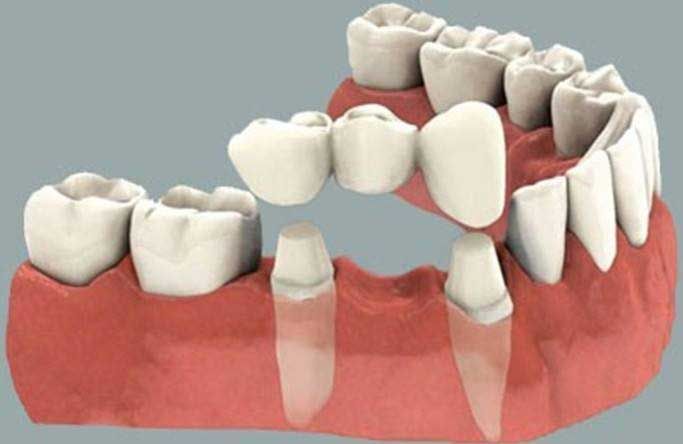 AB Dental - especialista en implantes dentales