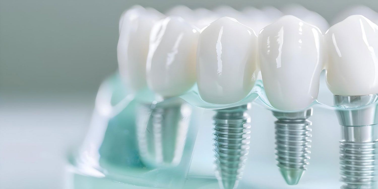 dental implants Chandler, AZ