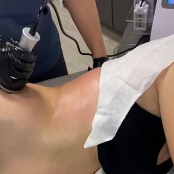 Persona recibiendo un procedimiento médico en la espalda. Un técnico utiliza un dispositivo con un guante negro. La piel está enrojecida.