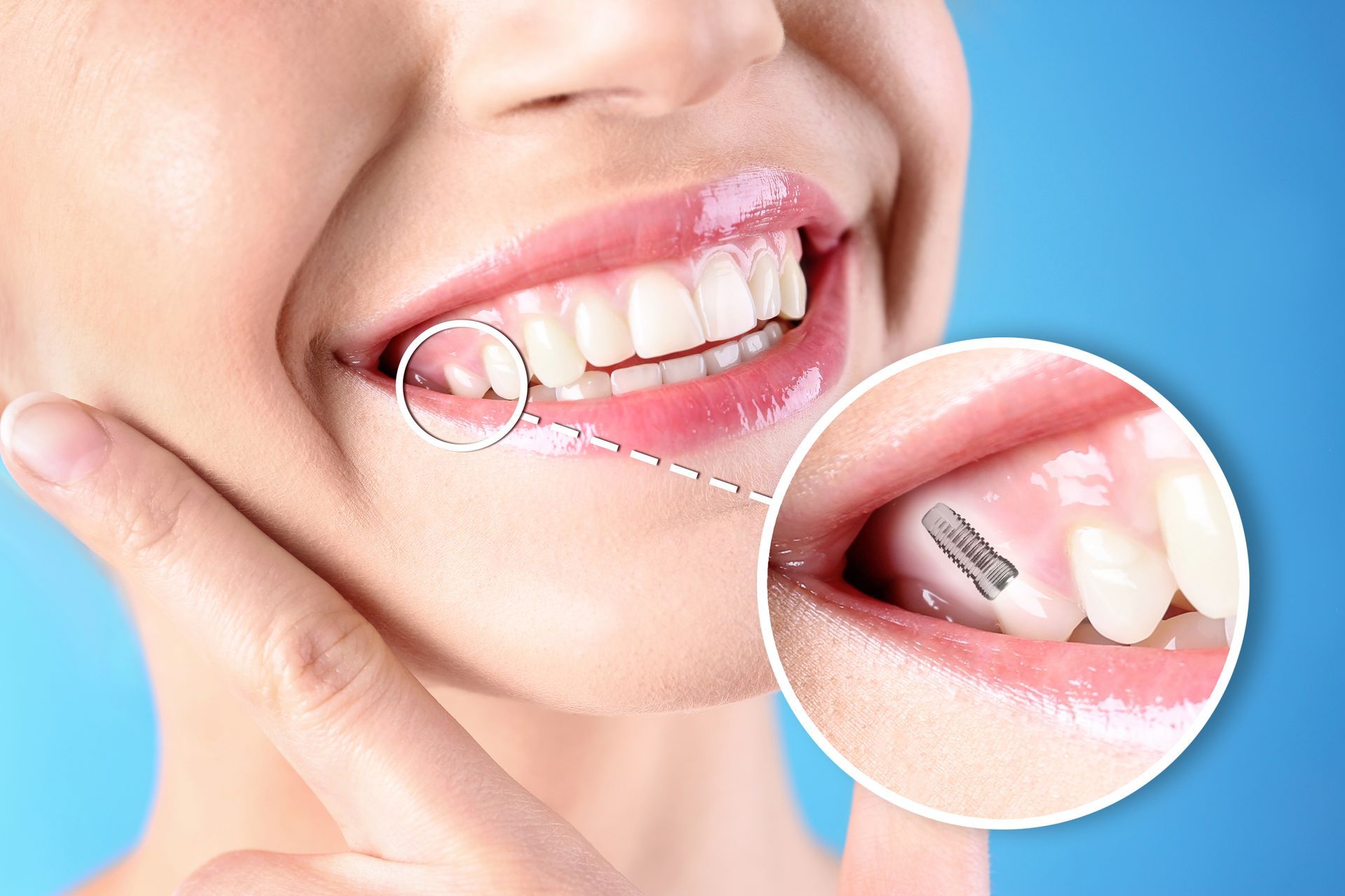 Close-up smile showing a dental implant in the gum with a magnified inset view.