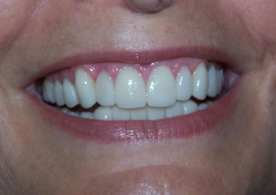 A close up of a woman 's smile with white teeth