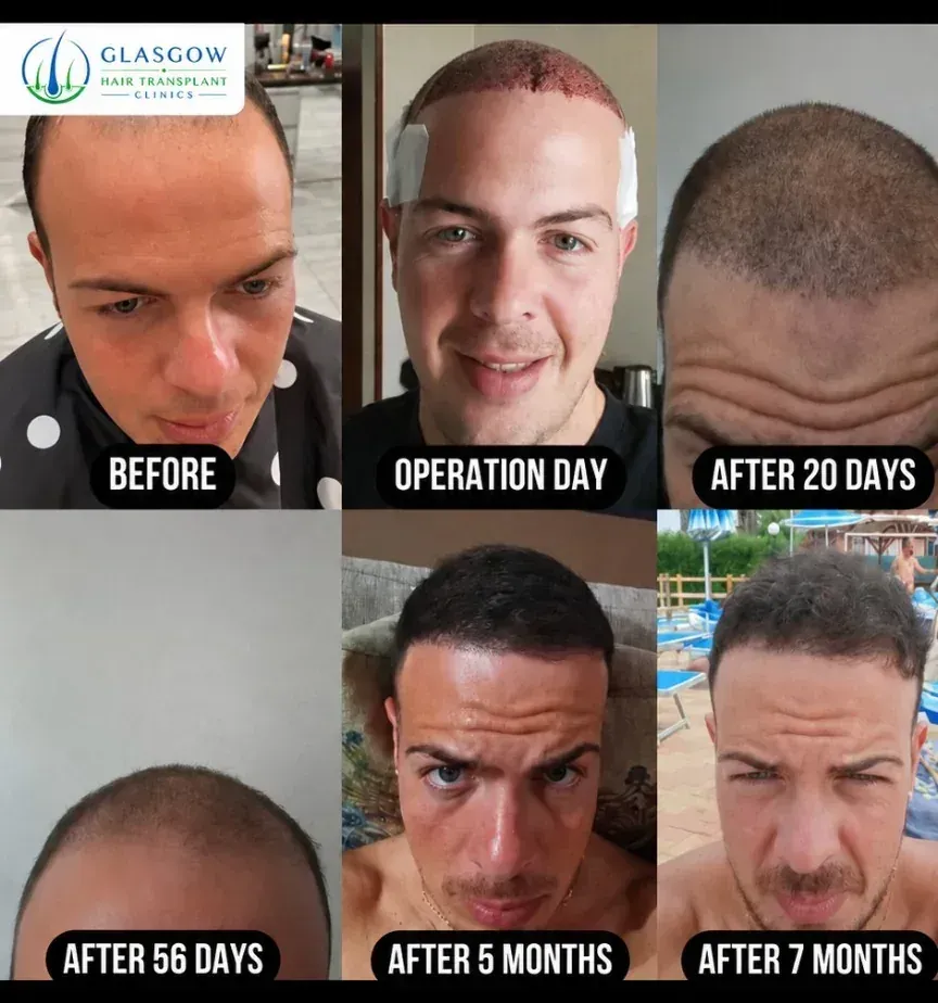 Hair transplant before and after result