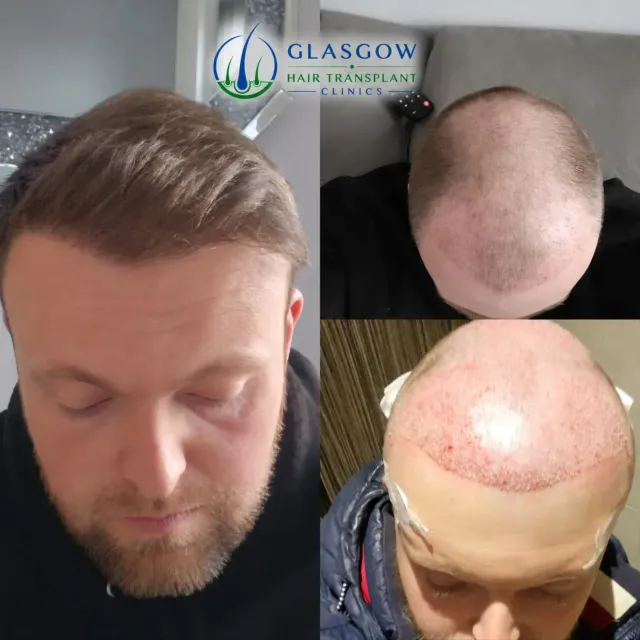 DHI hair transplant treatment result