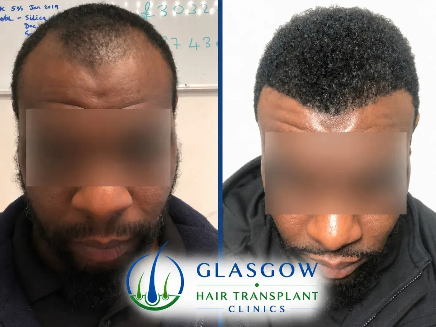 Afro hair transplant before and after result
