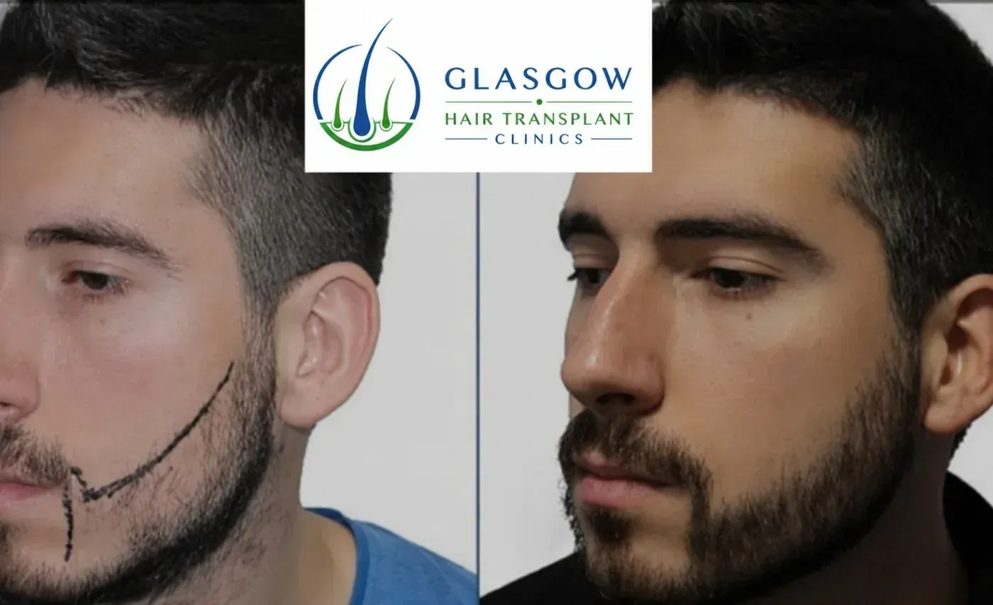 Beard transplant before and after cheek and jawline result