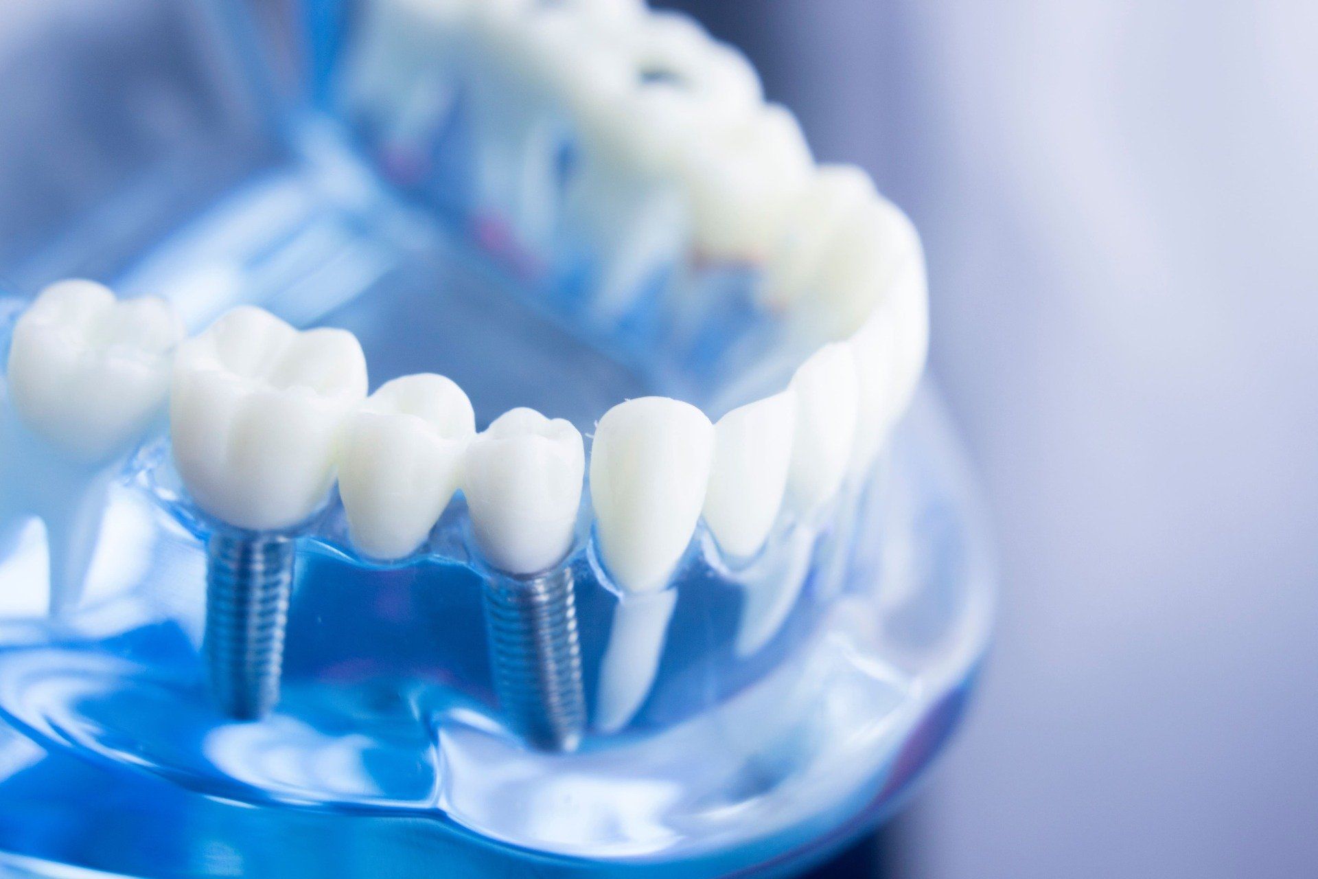 Woraus besteht eigentlich ein Zahnimplantat?