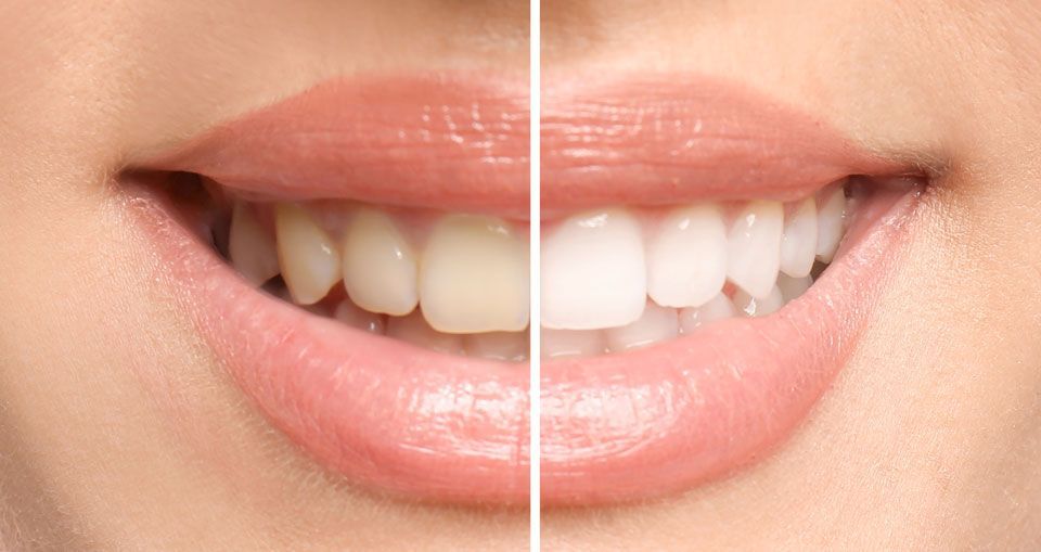 Schöne Zähne mit verschiedenen Zahnfarben
