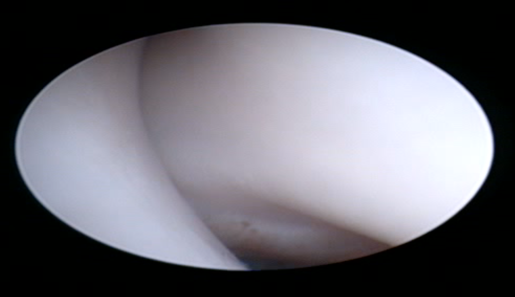 Foto Artroscopia