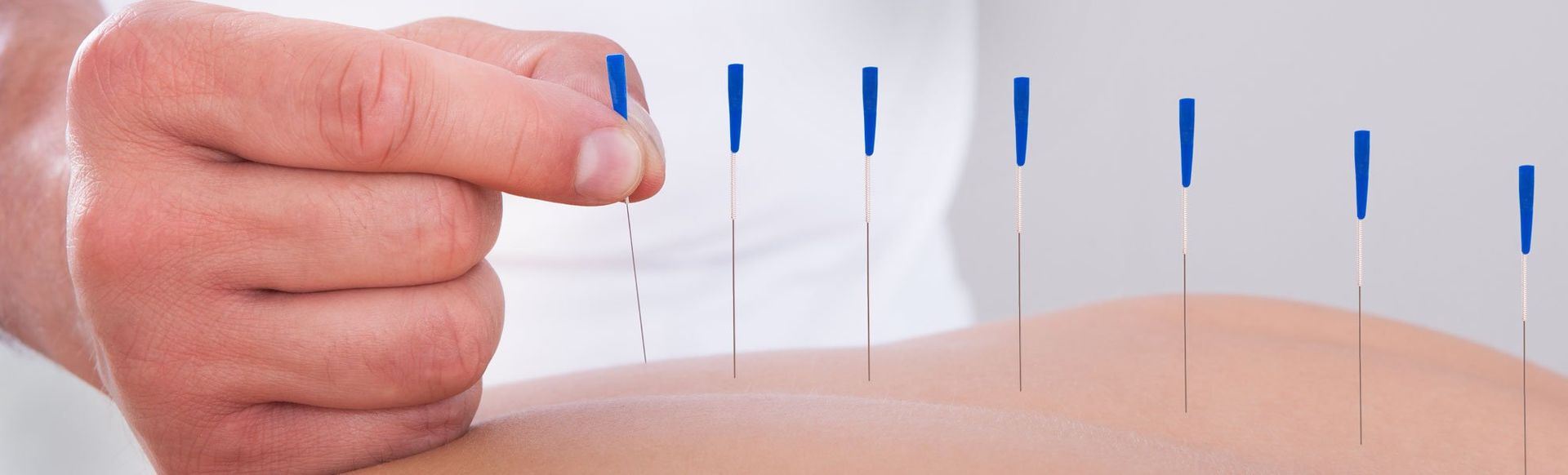 traditional Chinese acupuncture