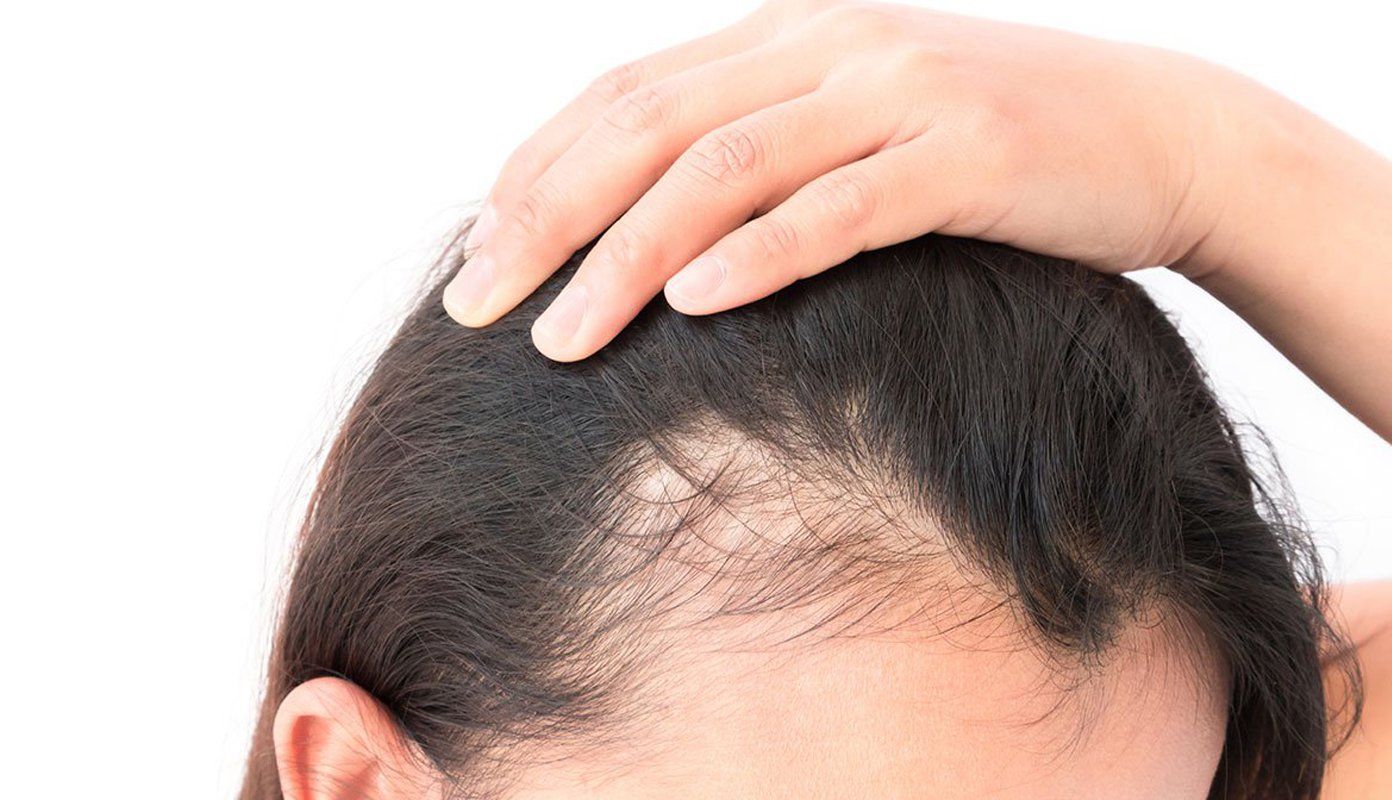 Una mujer con una calva en la cabeza se toca el cabello.