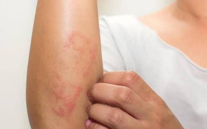 Una mujer se rasca el brazo que tiene un sarpullido.