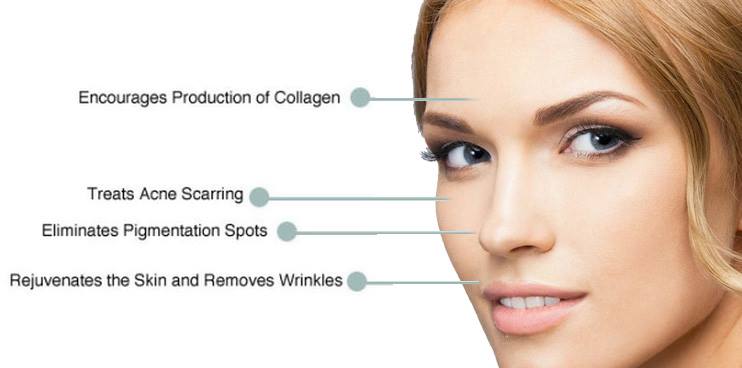 Micro-Needling Boston Rhode Island