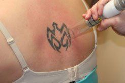 Tattoo Removal in Boston, MA | Providence, RI
