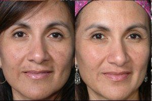 Sundamage-Removal-Before-After