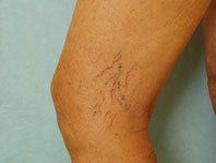 Leg-Spider-Vein-Removal-Andover