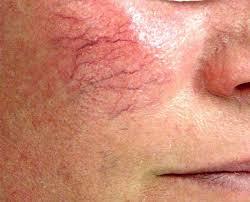 Remove Spider Veins on Face or Nose