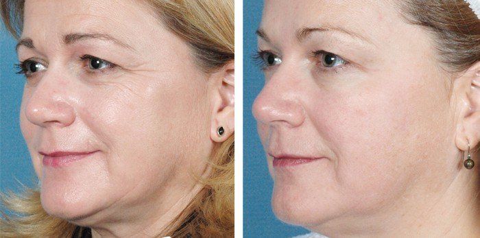 repair facial skin boston rhode island