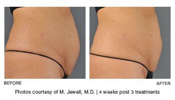 UltraShape-Abdomen-Before-After-Photos