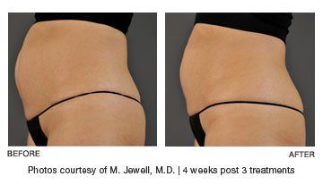 Ultrashape-Power-Belly-Fat-Removal-Boston-RI