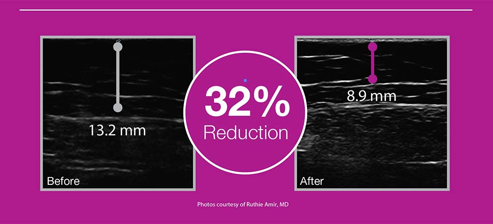 33%-Fat-Reduction-UltraShape