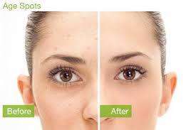 Remove Age Spots or Sun damage on Face in Boston and Rhode Island