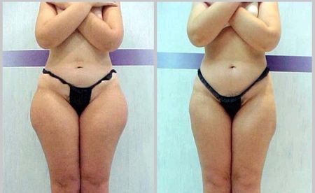 Ultrashape-before-after-outer-thigh