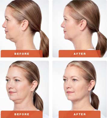 Kybella-Results-Women-Boston