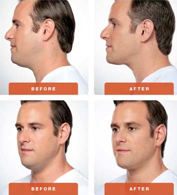 Kybella-Results-Men-Rhode-Island