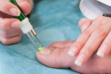 Laser-Nail-Fungus-Treatment-Andover