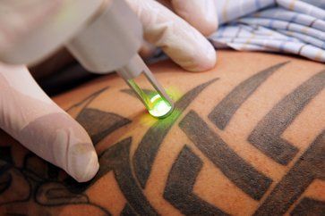 Remove-Tattoo-Laser