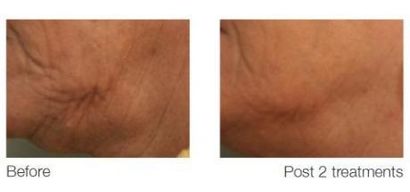 Ematrix skin tightening on neck