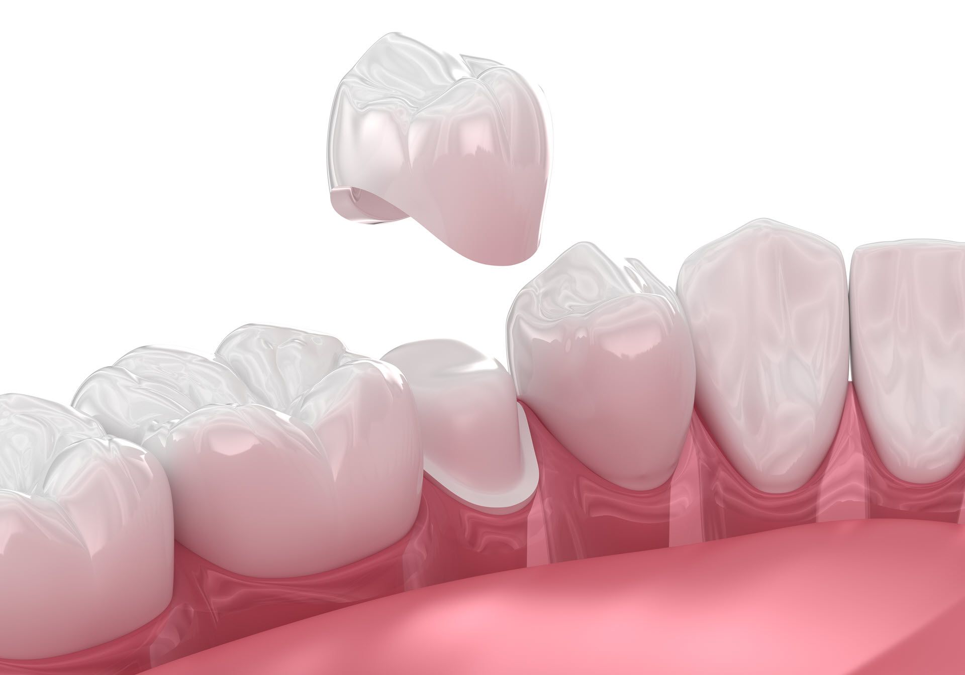 What is a dental crown Artin dental Toronto