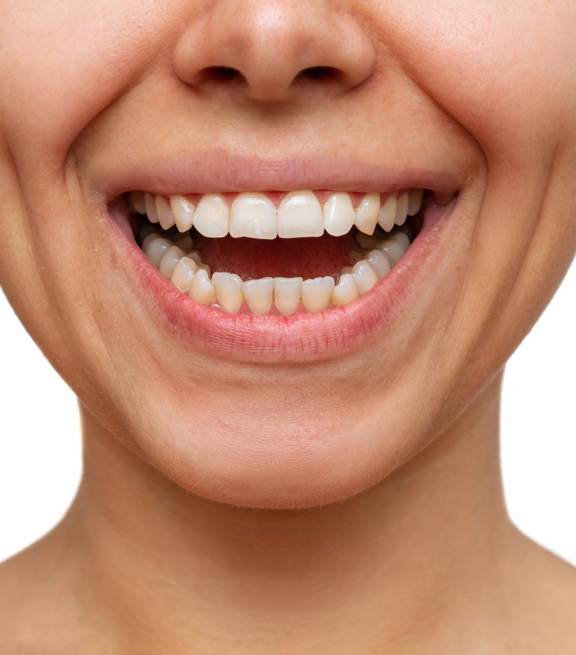 Before Dental Cleaning