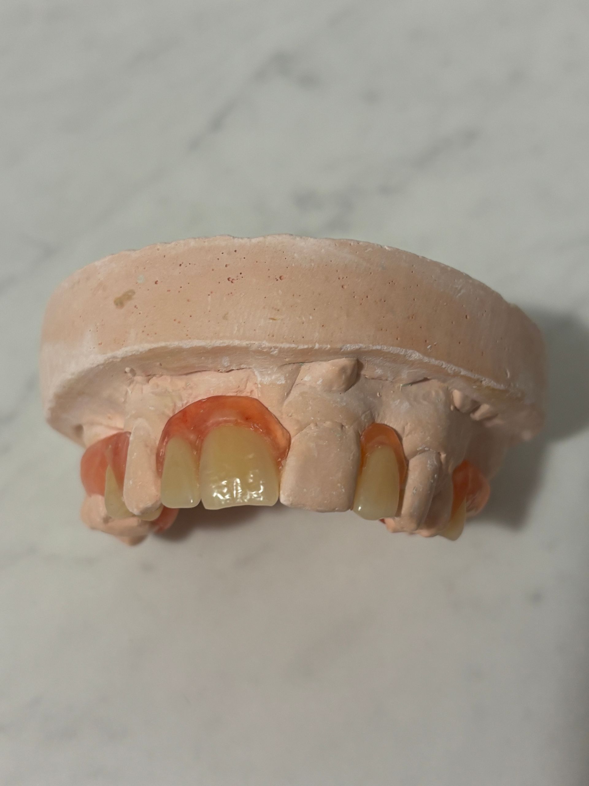Dental Model With Several Front Teeth and Pink Gums, Showing Chipped and Missing Teeth — Precise Dentures in Berserker, QLD