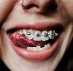 Close-up of a person's mouth. They are smiling with tongue touching teeth, showing metal braces and a nose ring.