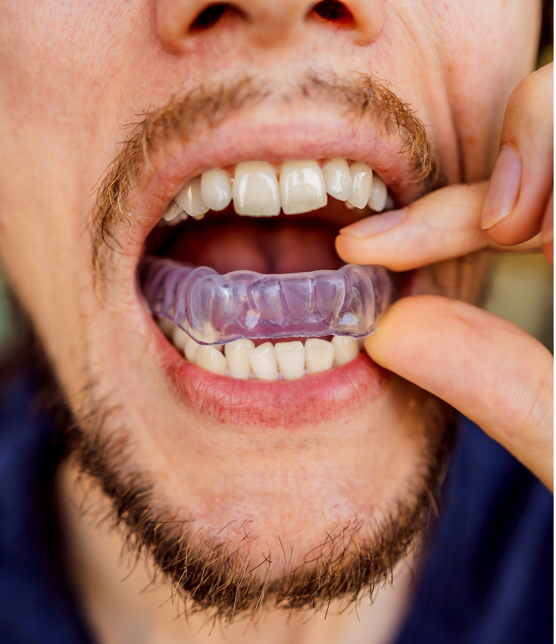 Person holding a transparent dental guard in their mouth, showing teeth.